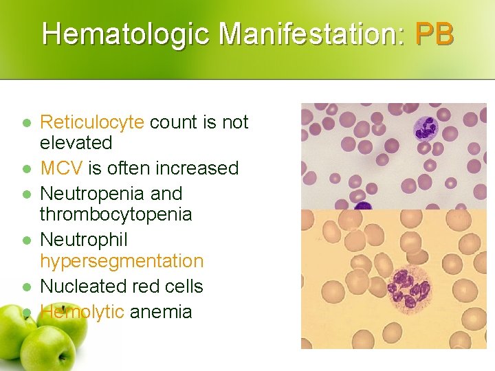 Hematologic Manifestation: PB l l l Reticulocyte count is not elevated MCV is often