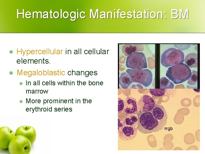 Hematologic Manifestation: BM l l Hypercellular in all cellular elements. Megaloblastic changes l l