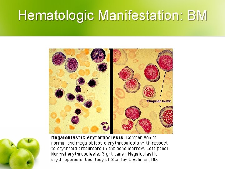 Hematologic Manifestation: BM 