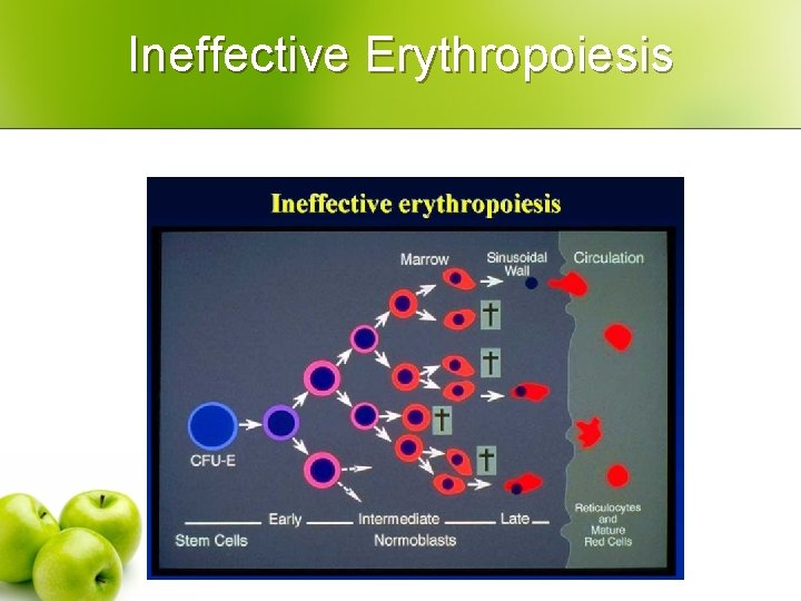Ineffective Erythropoiesis 