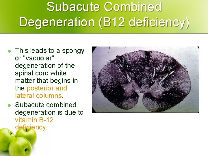 Subacute Combined Degeneration (B 12 deficiency) l l This leads to a spongy or