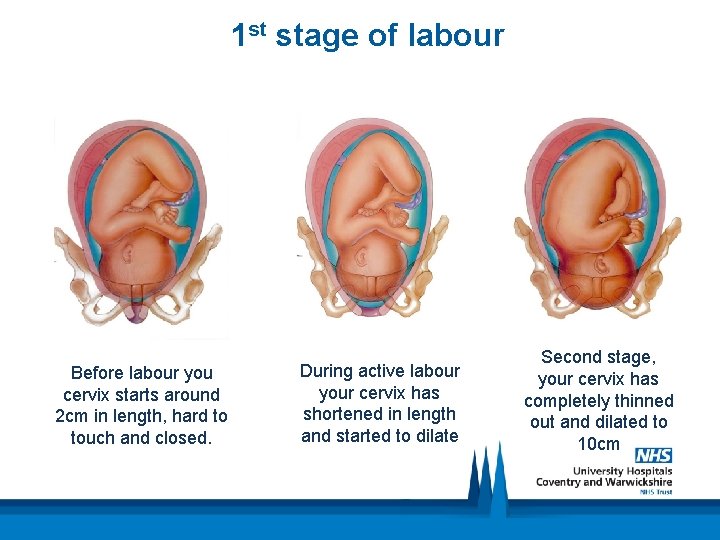 1 st stage of labour Before labour you cervix starts around 2 cm in