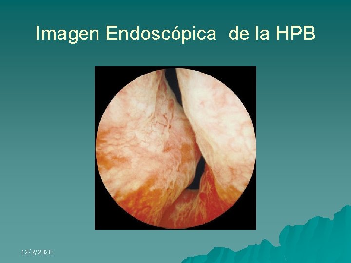 Imagen Endoscópica de la HPB 12/2/2020 
