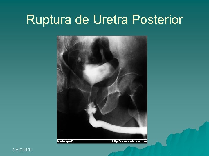 Ruptura de Uretra Posterior 12/2/2020 