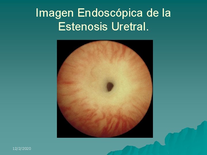 Imagen Endoscópica de la Estenosis Uretral. 12/2/2020 