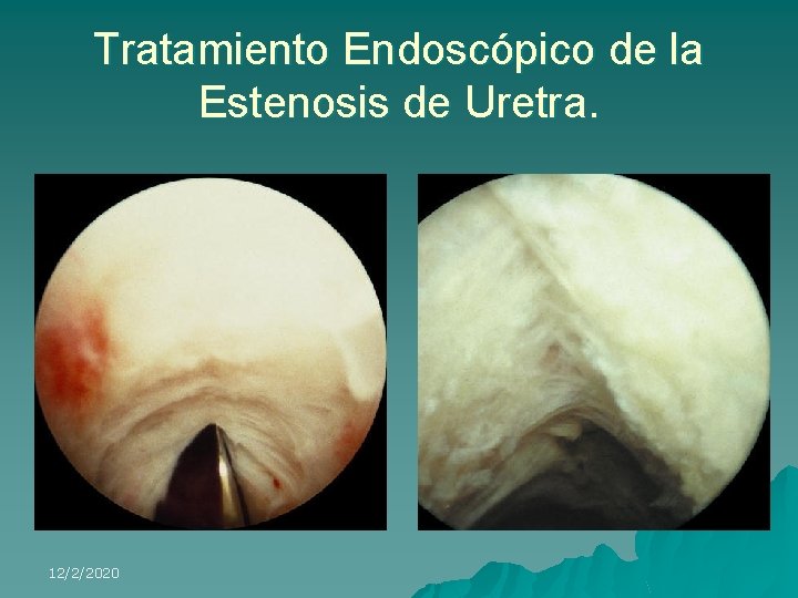 Tratamiento Endoscópico de la Estenosis de Uretra. 12/2/2020 