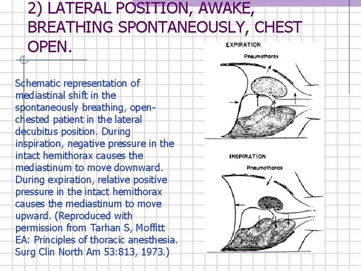 2) LATERAL POSITION, AWAKE, BREATHING SPONTANEOUSLY, CHEST OPEN. Schematic representation of mediastinal shift in