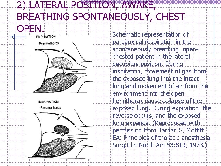 2) LATERAL POSITION, AWAKE, BREATHING SPONTANEOUSLY, CHEST OPEN. Schematic representation of paradoxical respiration in
