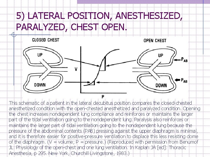 5) LATERAL POSITION, ANESTHESIZED, PARALYZED, CHEST OPEN. This schematic of a patient in the