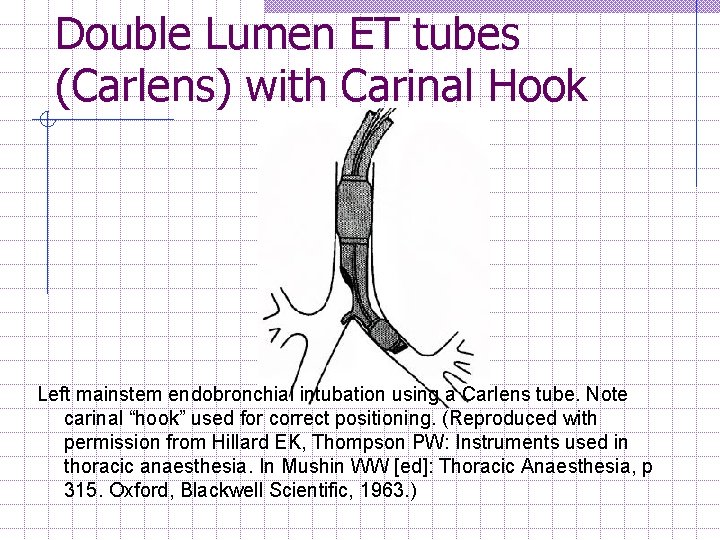 Double Lumen ET tubes (Carlens) with Carinal Hook Left mainstem endobronchial intubation using a