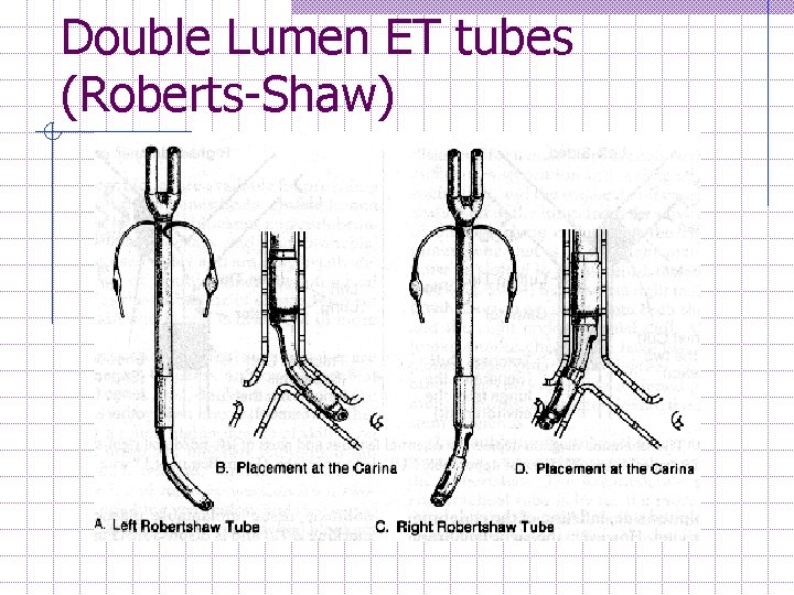 Double Lumen ET tubes (Roberts-Shaw) 