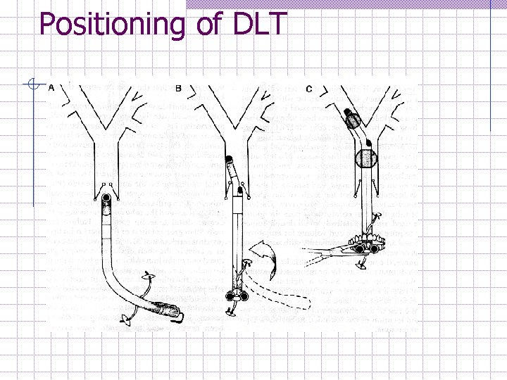 Positioning of DLT 