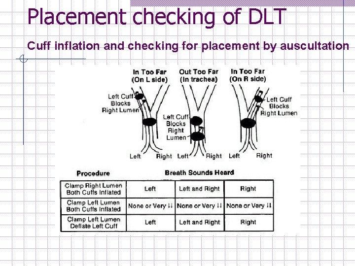 Placement checking of DLT Cuff inflation and checking for placement by auscultation 