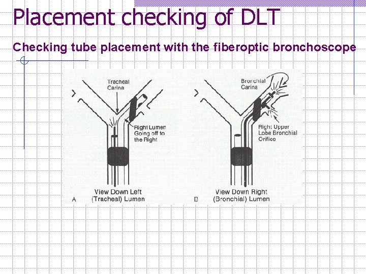 Placement checking of DLT Checking tube placement with the fiberoptic bronchoscope 