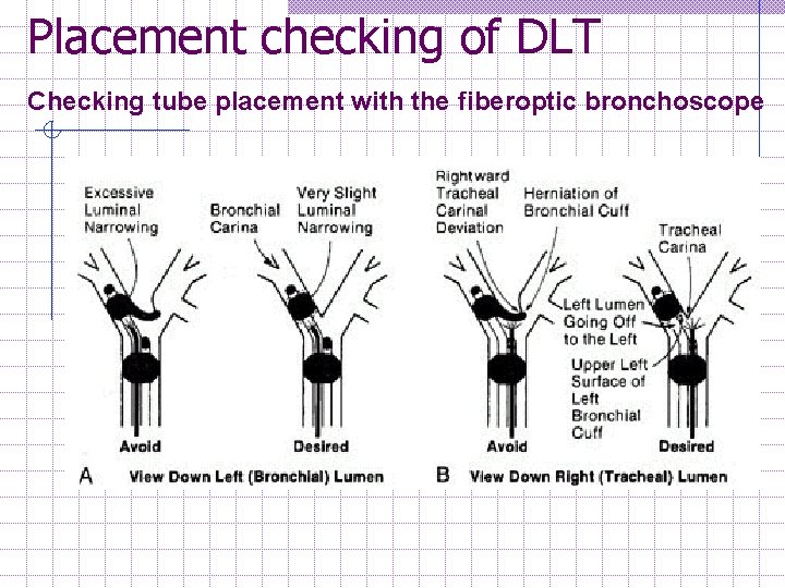 Placement checking of DLT Checking tube placement with the fiberoptic bronchoscope 