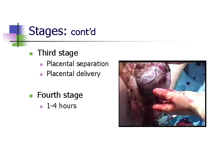 Stages: n Third stage n n n cont’d Placental separation Placental delivery Fourth stage