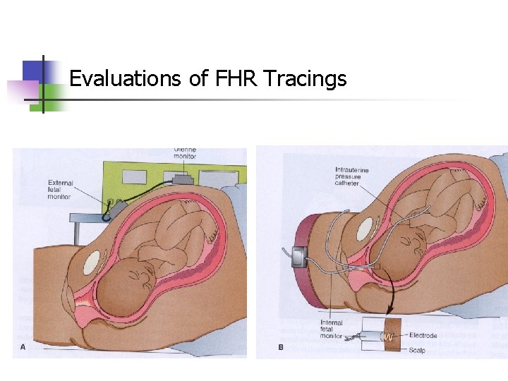 Evaluations of FHR Tracings 