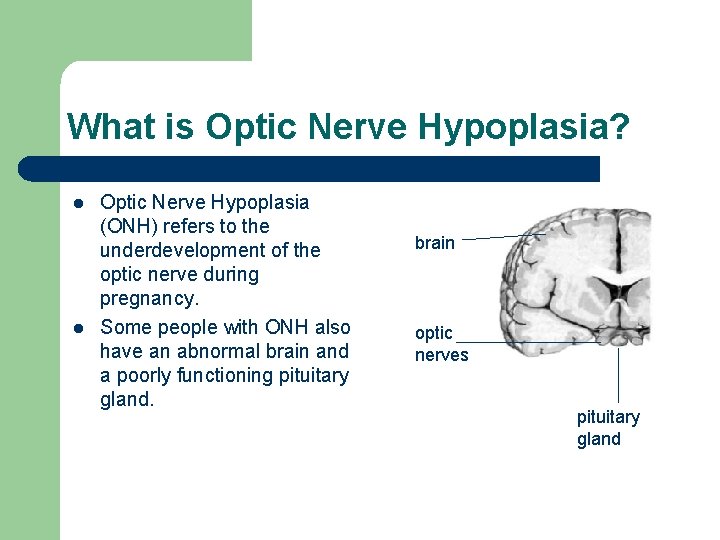 What is Optic Nerve Hypoplasia? l l Optic Nerve Hypoplasia (ONH) refers to the