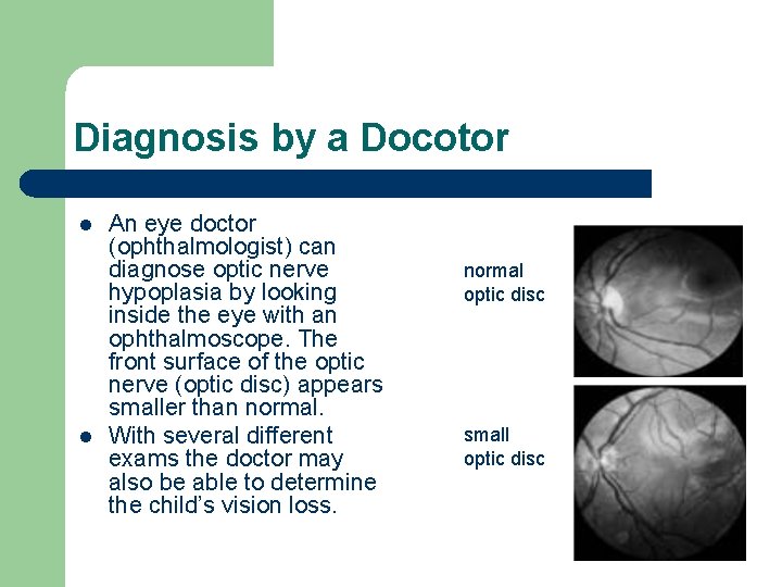 Diagnosis by a Docotor l l An eye doctor (ophthalmologist) can diagnose optic nerve