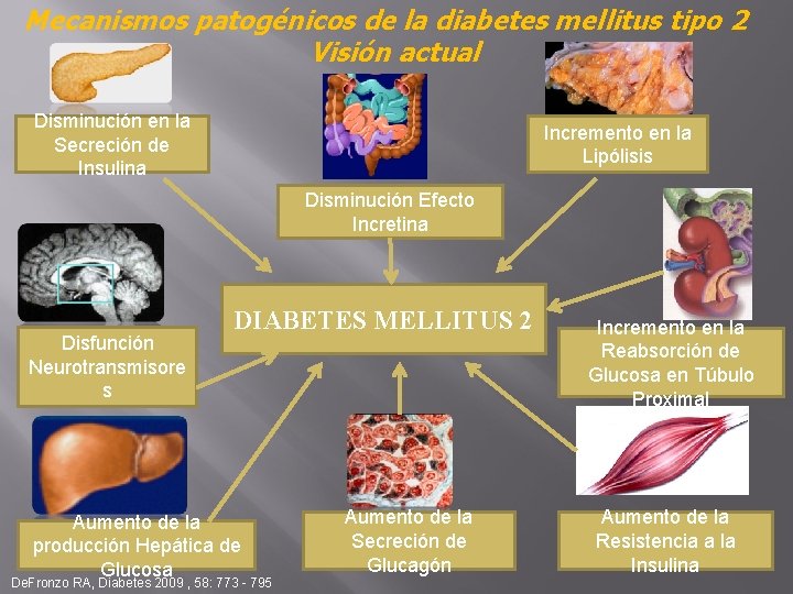 Mecanismos patogénicos de la diabetes mellitus tipo 2 Visión actual Disminución en la Secreción