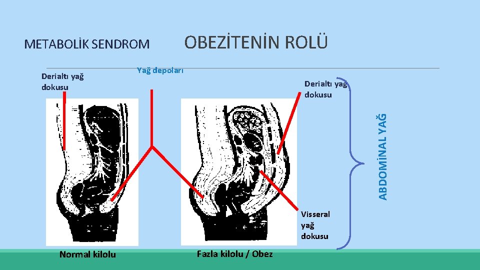 METABOLİK SENDROM Yağ depoları Derialtı yağ dokusu ABDOMİNAL YAĞ Derialtı yağ dokusu OBEZİTENİN ROLÜ