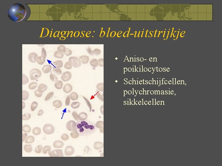 Diagnose: bloed-uitstrijkje • Aniso- en poikilocytose • Schietschijfcellen, polychromasie, sikkelcellen 