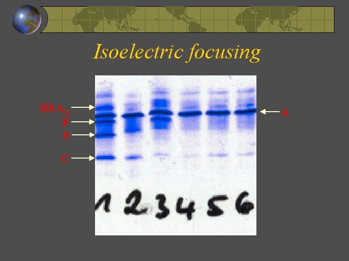 Isoelectric focusing Hb. A 1 c F S C A 