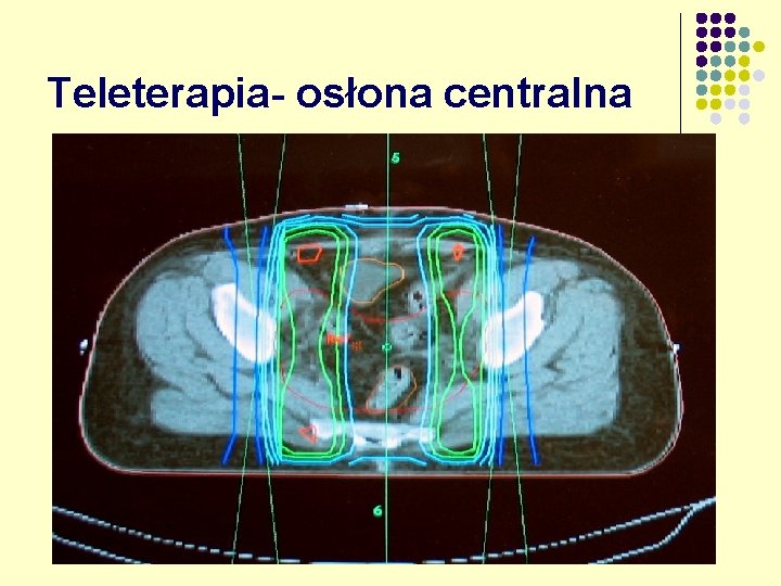 Teleterapia- osłona centralna 
