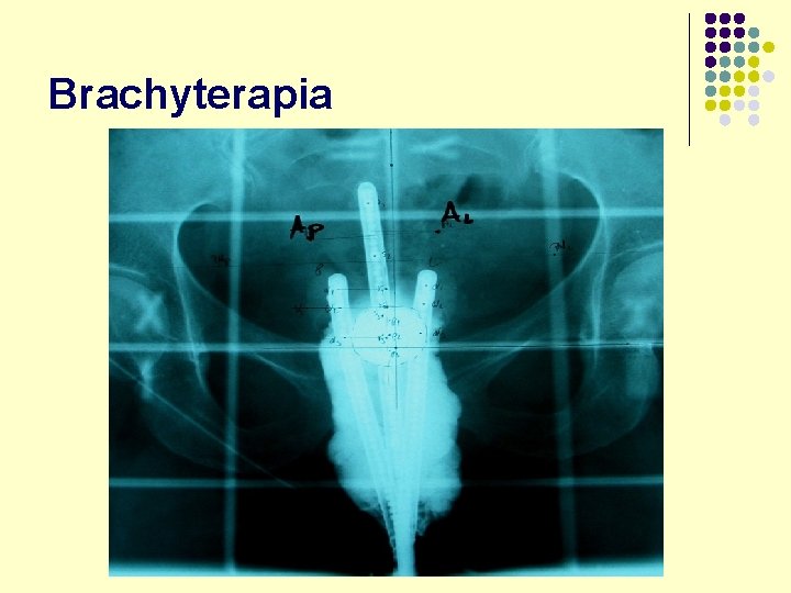 Brachyterapia 