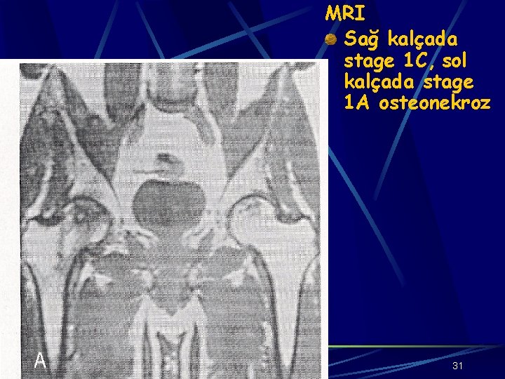 MRI Sağ kalçada stage 1 C, sol kalçada stage 1 A osteonekroz 31 