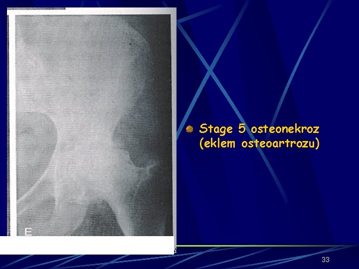 Stage 5 osteonekroz (eklem osteoartrozu) 33 