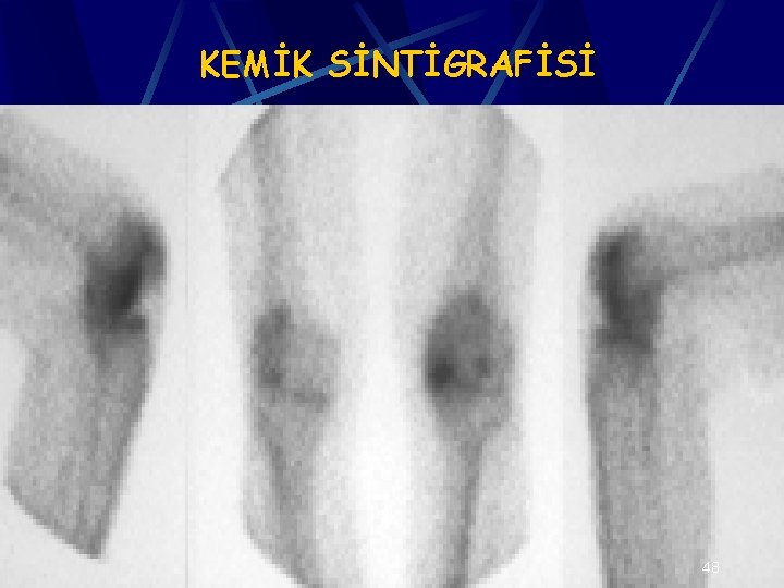 KEMİK SİNTİGRAFİSİ 48 