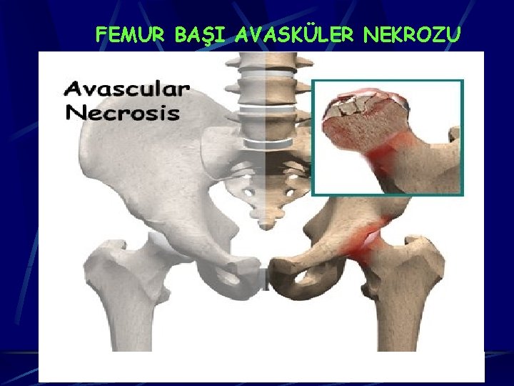 FEMUR BAŞI AVASKÜLER NEKROZU 8 