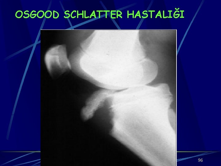 OSGOOD SCHLATTER HASTALIĞI 96 