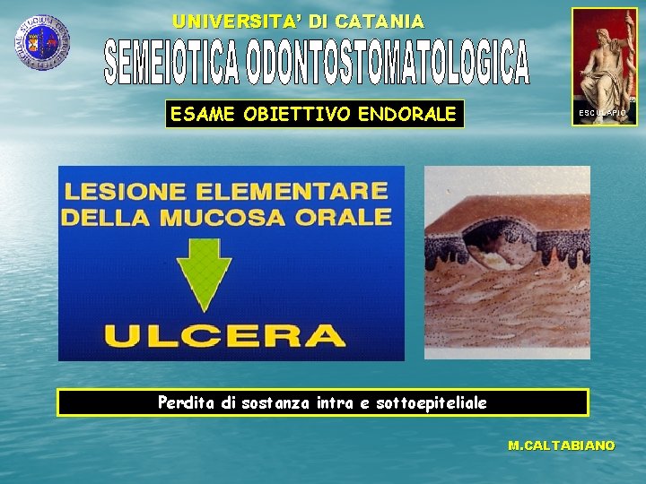 UNIVERSITA’ DI CATANIA ESAME OBIETTIVO ENDORALE ESCULAPIO Perdita di sostanza intra e sottoepiteliale M.