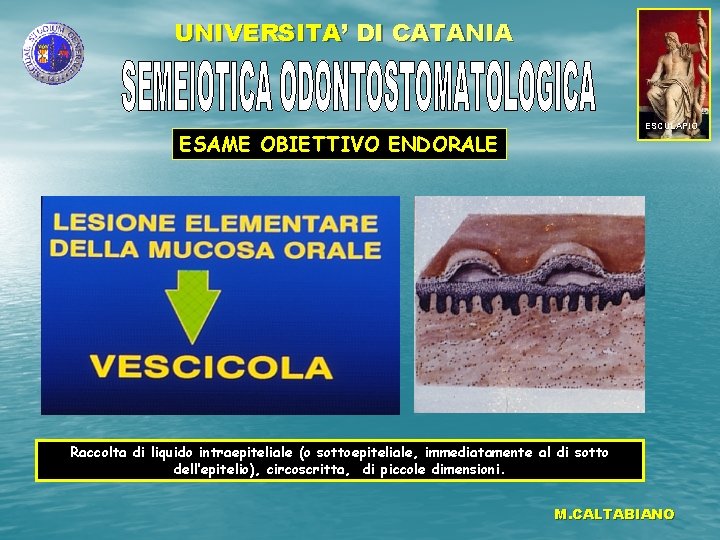 UNIVERSITA’ DI CATANIA ESCULAPIO ESAME OBIETTIVO ENDORALE Raccolta di liquido intraepiteliale (o sottoepiteliale, immediatamente