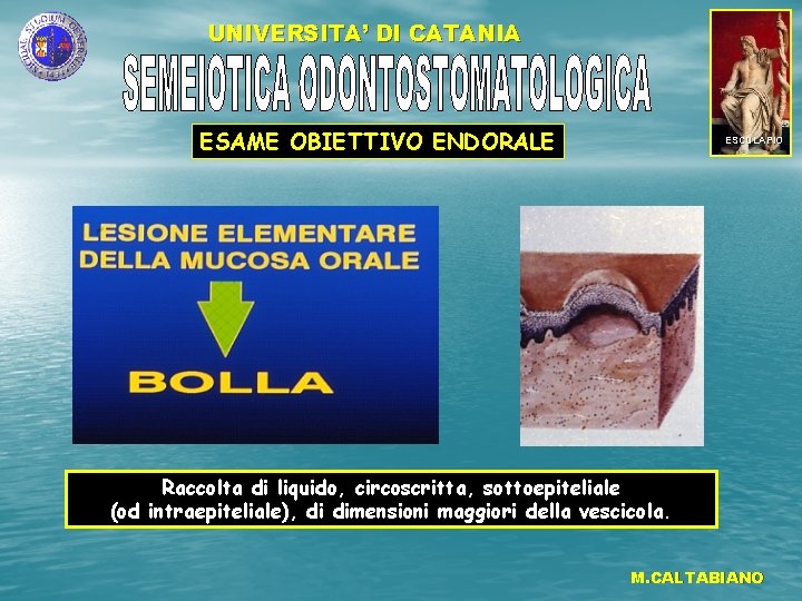 UNIVERSITA’ DI CATANIA ESAME OBIETTIVO ENDORALE ESCULAPIO Raccolta di liquido, circoscritta, sottoepiteliale (od intraepiteliale),