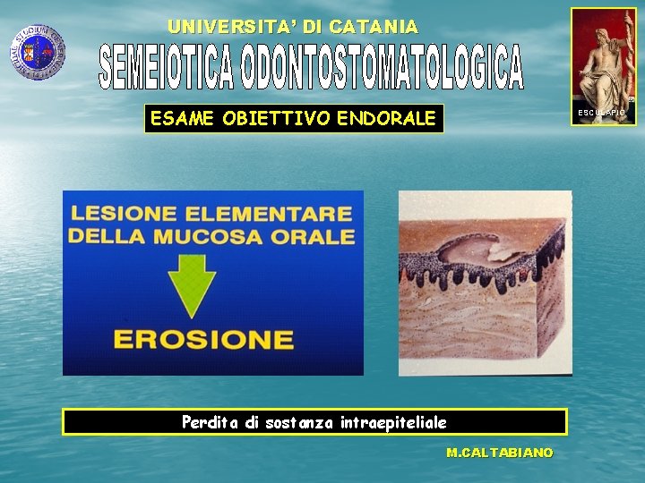 UNIVERSITA’ DI CATANIA ESAME OBIETTIVO ENDORALE ESCULAPIO Perdita di sostanza intraepiteliale M. CALTABIANO 