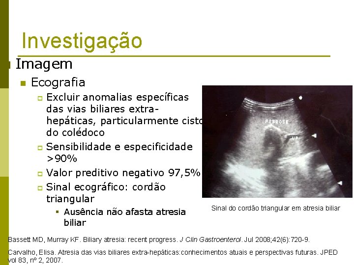 Investigação p Imagem n Ecografia Excluir anomalias específicas das vias biliares extrahepáticas, particularmente cisto