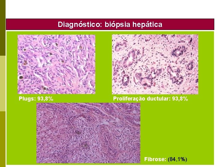 Diagnóstico: biópsia hepática Plugs: 93, 8% Proliferação ductular: 93, 8% Fibrose: (84, 1%) 