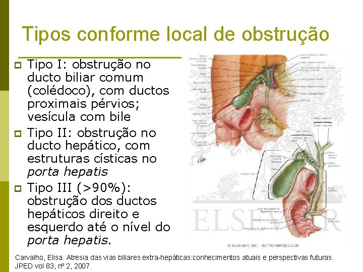 Tipos conforme local de obstrução p p p Tipo I: obstrução no ducto biliar