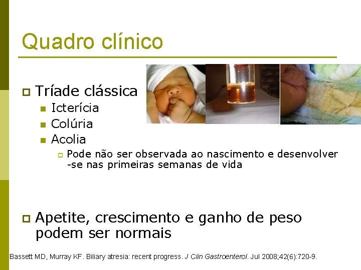 Quadro clínico p Tríade clássica n n n Icterícia Colúria Acolia p p Pode