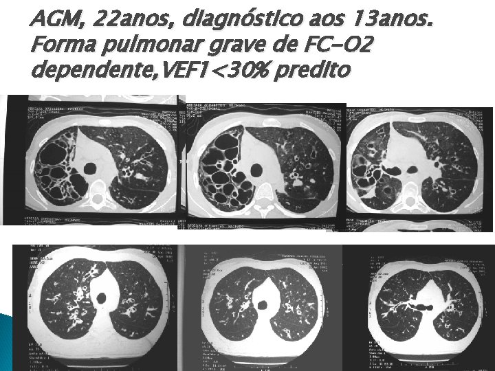 AGM, 22 anos, diagnóstico aos 13 anos. Forma pulmonar grave de FC-O 2 dependente,