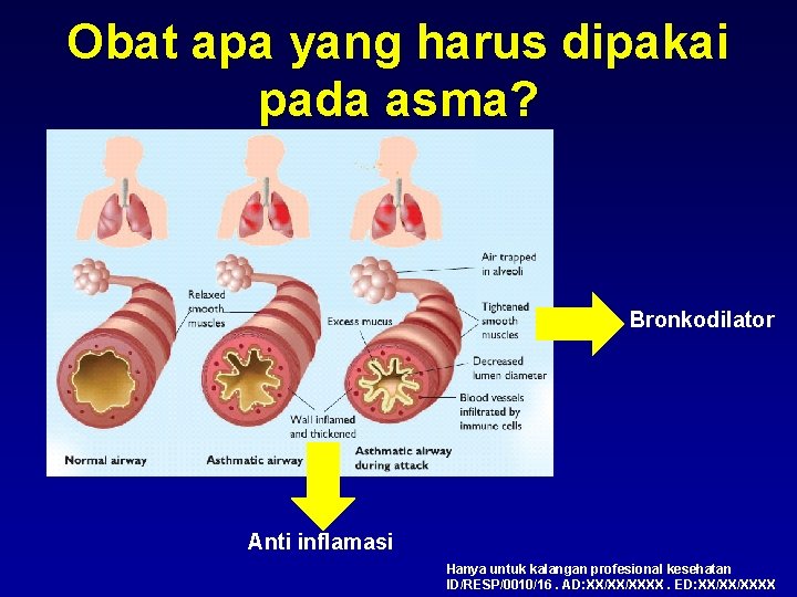 Obat apa yang harus dipakai pada asma? Bronkodilator Anti inflamasi Hanya untuk kalangan profesional