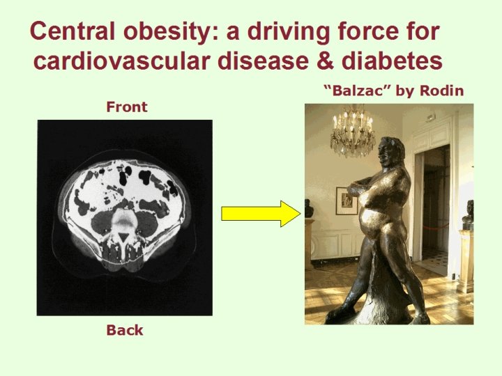 Central obesity: a driving force for cardiovascular disease & diabetes Front Back “Balzac” by