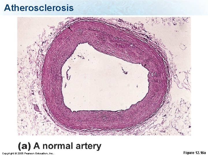 Atherosclerosis Copyright © 2009 Pearson Education, Inc. Figure 12. 16 a 