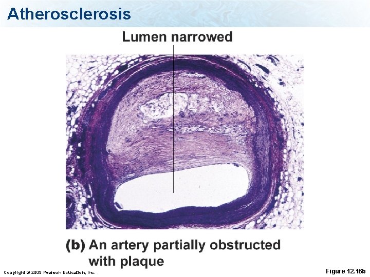 Atherosclerosis Copyright © 2009 Pearson Education, Inc. Figure 12. 16 b 