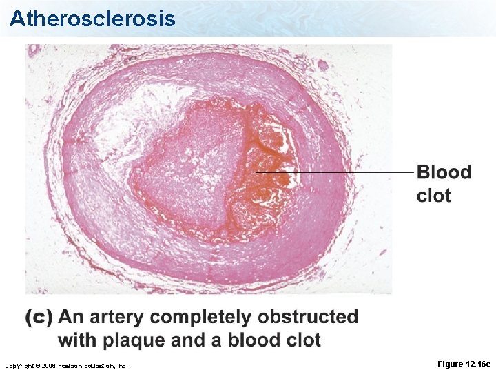 Atherosclerosis Copyright © 2009 Pearson Education, Inc. Figure 12. 16 c 