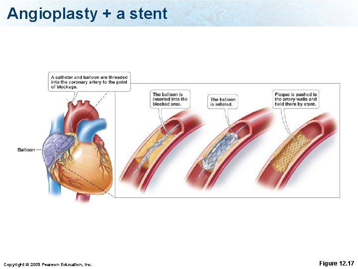 Angioplasty + a stent Copyright © 2009 Pearson Education, Inc. Figure 12. 17 