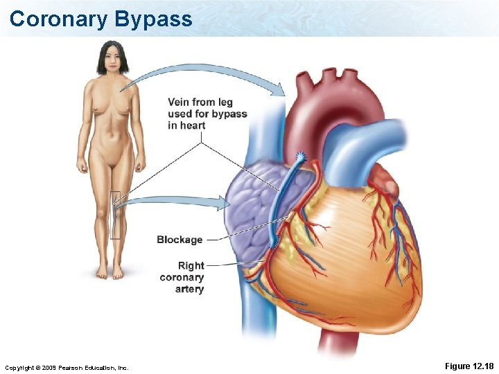 Coronary Bypass Copyright © 2009 Pearson Education, Inc. Figure 12. 18 
